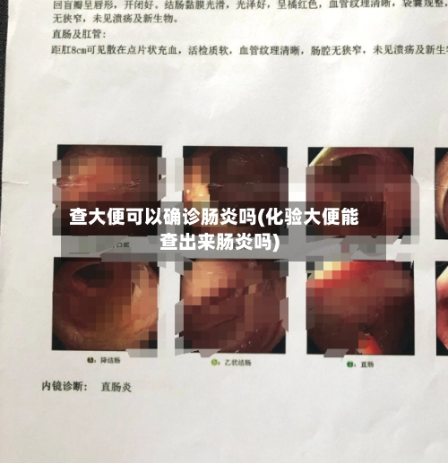 查大便可以确诊肠炎吗(化验大便能查出来肠炎吗)
