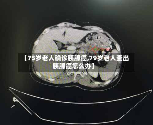 【75岁老人确诊胰腺癌,79岁老人查出胰腺癌怎么办】-第2张图片