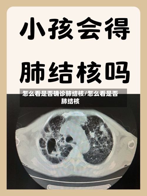 怎么看是否确诊肺结核/怎么看是否肺结核-第3张图片