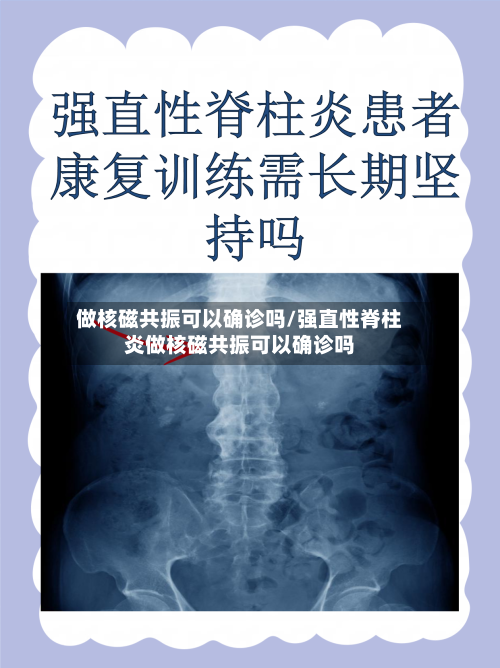 做核磁共振可以确诊吗/强直性脊柱炎做核磁共振可以确诊吗-第2张图片