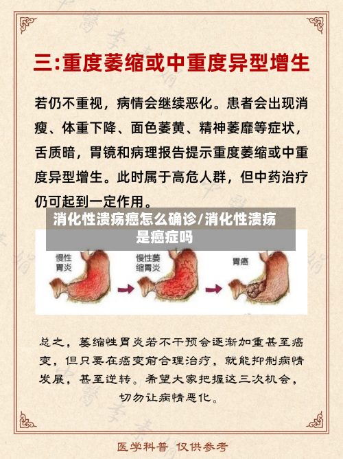 消化性溃疡癌怎么确诊/消化性溃疡是癌症吗