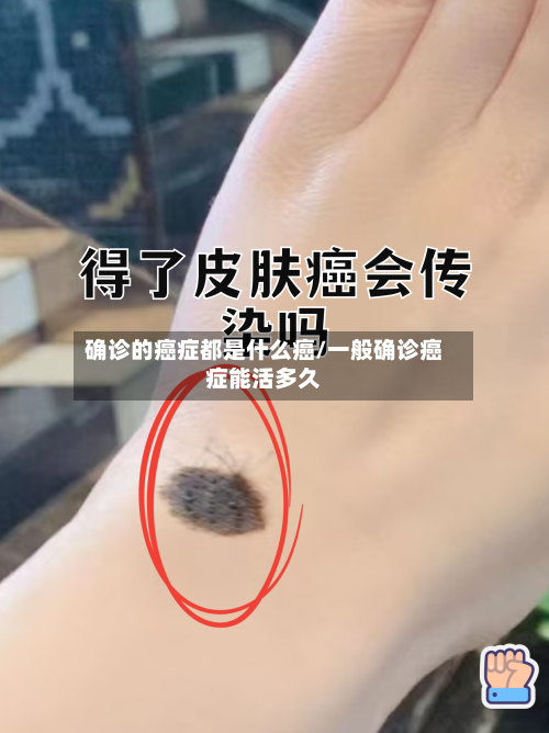 确诊的癌症都是什么癌/一般确诊癌症能活多久