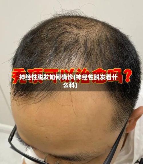 神经性脱发如何确诊(神经性脱发看什么科)