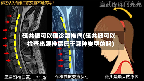 磁共振可以确诊颈椎病(磁共振可以检查出颈椎病属于哪种类型的吗)